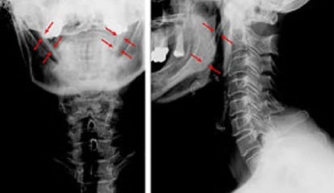 Síndrome de Eagle: médico alerta para doença de difícil diagnóstico e que causa muitas dores Síndrome de Eagle: médico alerta para doença de difícil diagnóstico e que causa muitas dores