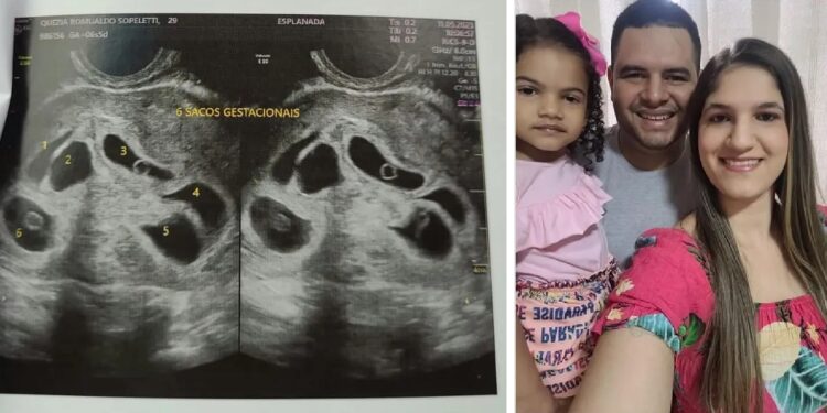 Médico de mulher que engravidou de sêxtuplos em Colatina, diz que gravidez é muito rara e de alto risco