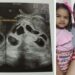 Médico de mulher que engravidou de sêxtuplos em Colatina, diz que gravidez é muito rara e de alto risco