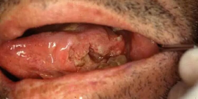 Cirurgião alerta para perigo do câncer na região bucal, que pode causar mutilações irreversíveis